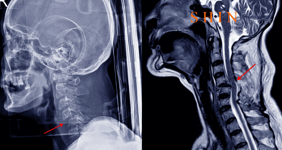 Neck Injury Claims in Virginia: A Guide for Accident Victims